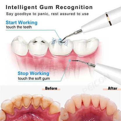 Smart Ultra-Sonic Teeth Cleaner